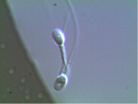 Espermatozoides con vacuolas