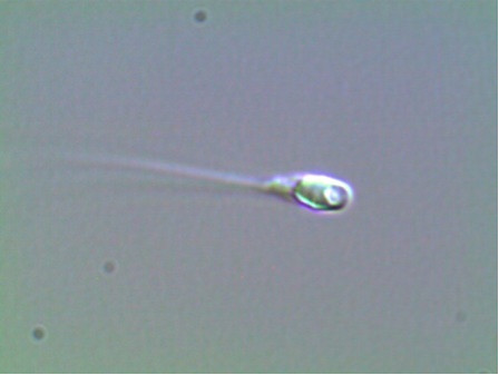 Espermatozoide con una gran vacuola.
